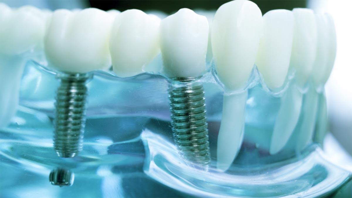 implant İmplant