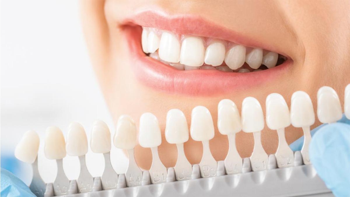 Vidasız implant Vidasız implant