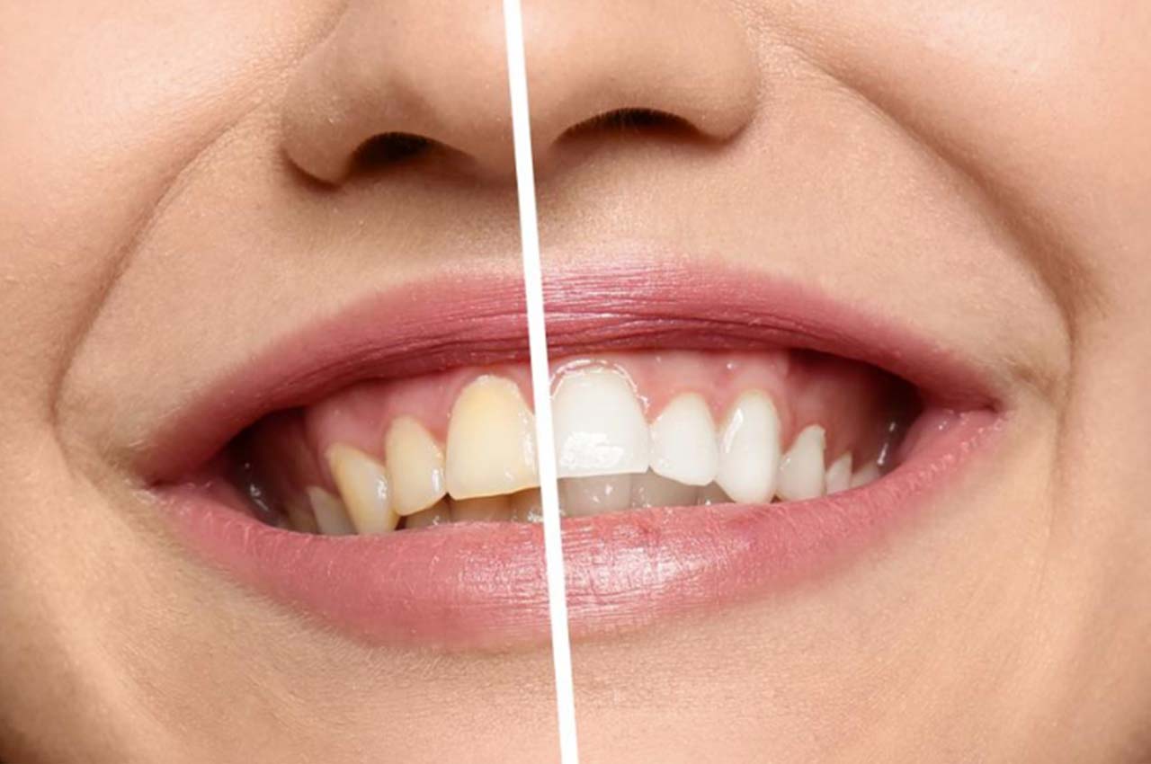 Diş beyazlatma öncesi ve sonrası, Samsun diş beyazlatma, Samsun diş beyazlatma